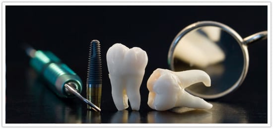 Immediate implant placement Immediate implant placement
