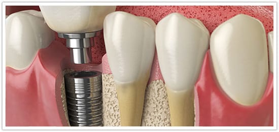 Dental bone graft cost Dental bone graft cost