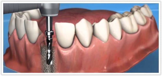 Low cost dental implants Low cost dental implants