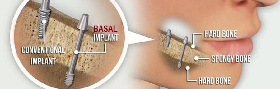 Basal implants in usa