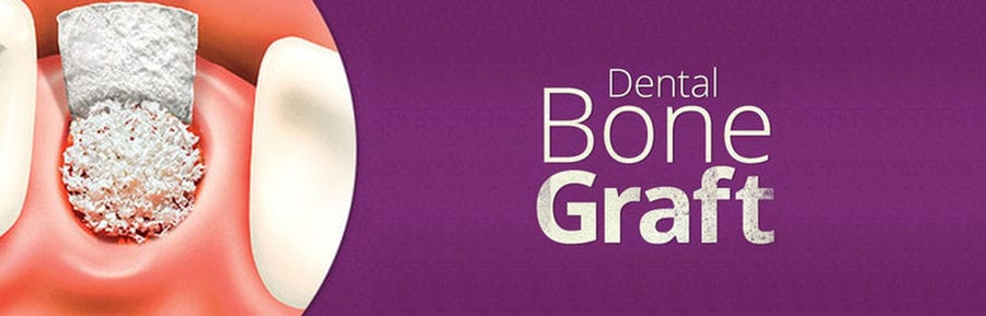 Bone graft dental