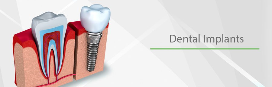 Permanent teeth implants